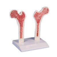 Erler Zimmer Osteoporose-Oberschenkel-Modell anatomisch,...