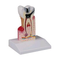 Zahnkariesmodell von Erler Zimmer, unteren Molar, 10-fach...