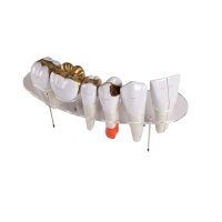 Zahnersatz-Modell von Erler Zimmer, 10-fache...