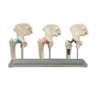 Erler Zimmer verkleinerte Hüft-Implantat-Modelle, 3...