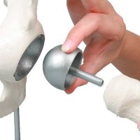 Erler Zimmer Hüftgelenk mit Schalenprothese -...