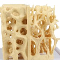 Erler Zimmer Modell - gesunde/osteoporotische...
