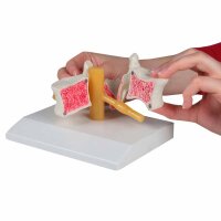 Erler Zimmer Modell Osteoporose-Wirbel, 2-fach...